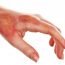 How to Cure Burns at Home Naturally?