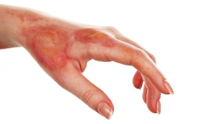 How to Cure Burns at Home Naturally?