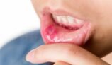 How to Cure Canker Sore or Mouth Ulcers at Home Naturally?