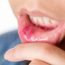 How to Cure Canker Sore or Mouth Ulcers at Home Naturally?