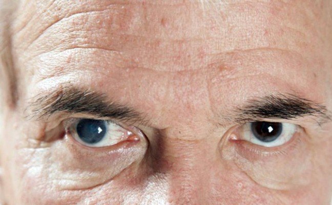 How to Cure Cataract at Home Naturally?