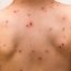 How to Cure Chickenpox at Home Naturally?