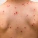 How to Cure Chickenpox at Home Naturally?