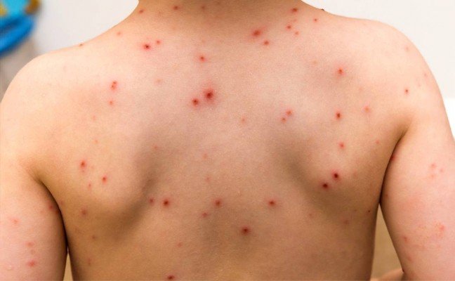 How to Cure Chickenpox at Home Naturally?