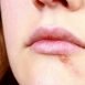 How to Cure Cold Sores at Home Naturally?