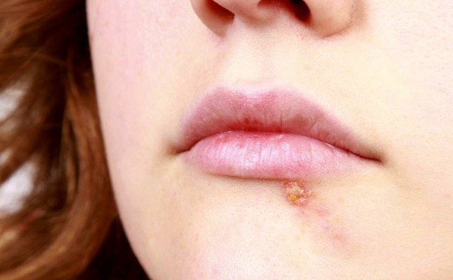 How to Cure Cold Sores at Home Naturally?