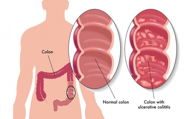 How to Cure Colitis at Home Naturally?