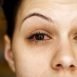 How to Cure Conjunctivitis at Home Naturally?