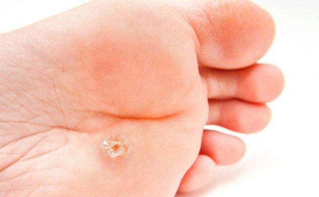 How to Cure Corns at Home Naturally?