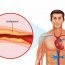 How to Cure Coronary Heart Disease at Home Naturally?