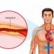 How to Cure Coronary Heart Disease at Home Naturally?