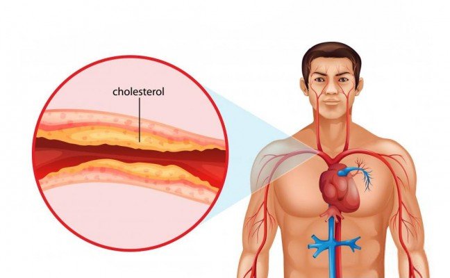 How to Cure Coronary Heart Disease at Home Naturally?