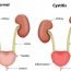 How to Cure Cystitis at Home Naturally?