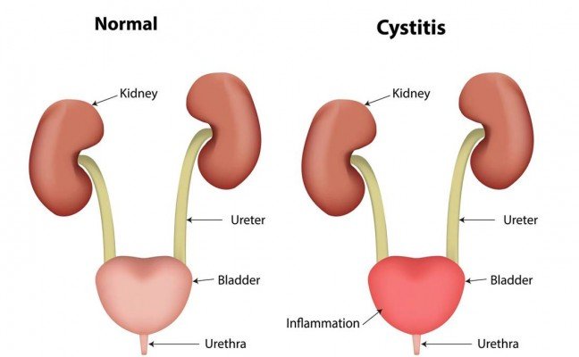 How to Cure Cystitis at Home Naturally? How to Cure Cystitis at Home Naturally?