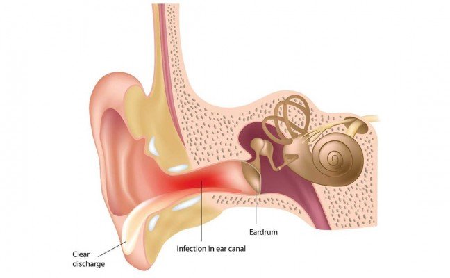 How to Cure Ear Infection at Home Naturally?