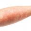 How to Cure Eczema at Home Naturally?