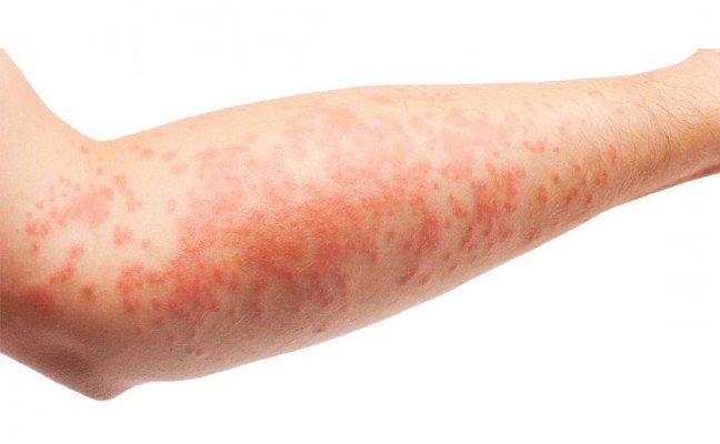 How to Cure Eczema at Home Naturally?