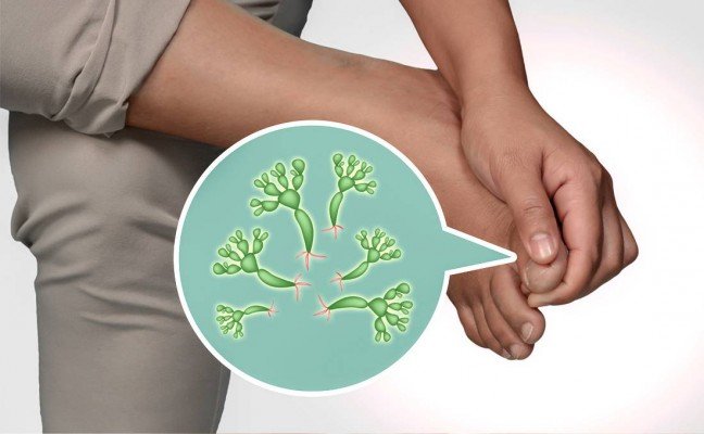 How to Cure Fungal Infections at Home Naturally? How to Cure Fungal Infections at Home Naturally?