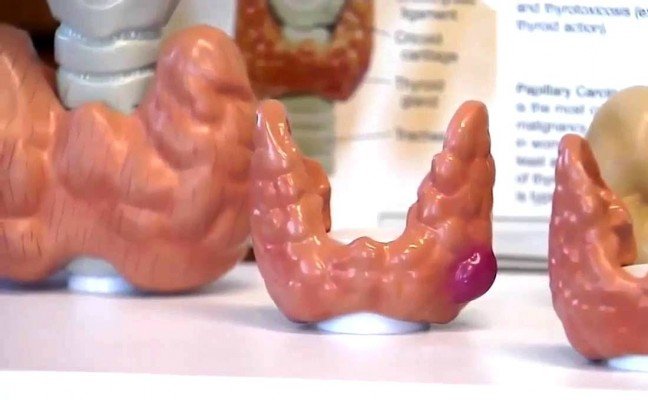 How to Cure Goitre at Home Naturally? How to Cure Goitre at Home Naturally?