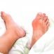 How to Cure Gout at Home Naturally?