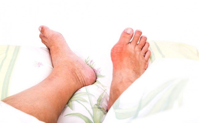 How to Cure Gout at Home Naturally?