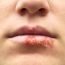 How to Cure Herpes at Home Naturally?