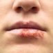 How to Cure Herpes at Home Naturally?
