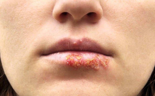 How to Cure Herpes at Home Naturally? How to Cure Herpes at Home Naturally?