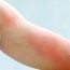 How to Cure Hives at Home Naturally?
