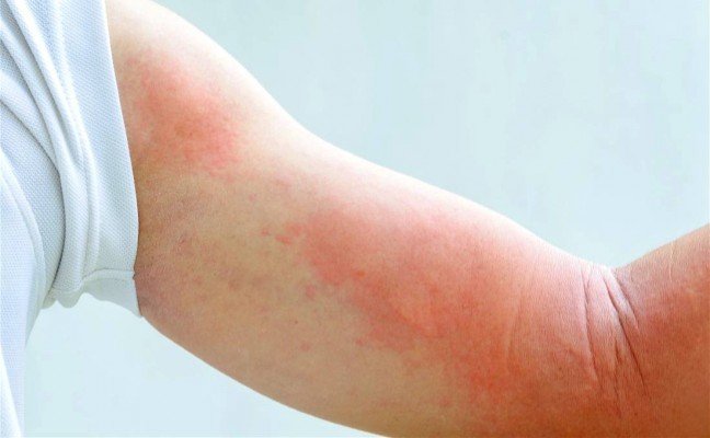 How to Cure Hives at Home Naturally? How to Cure Hives at Home Naturally?
