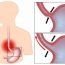 How to Cure Indigestion at Home Naturally?
