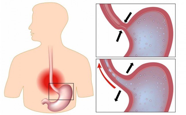 How to Cure Indigestion at Home Naturally?