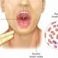 How to Cure Infectious Mononucleosis Naturally?