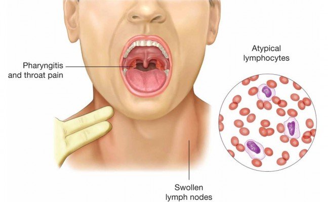 How to Cure Infectious Mononucleosis Naturally?