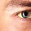 How to Cure Jaundice at Home Naturally?