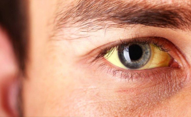 How to Cure Jaundice at Home Naturally?