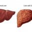 How to Cure Liver Disease at Home Naturally?