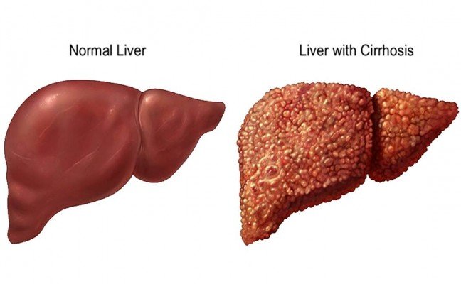 How to Cure Liver Disease at Home Naturally? How to Cure Liver Disease at Home Naturally?