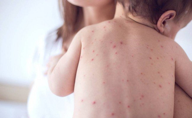 How to Cure Measles at Home Naturally?