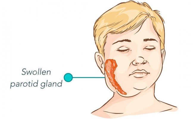 How to Cure Mumps at Home Naturally?