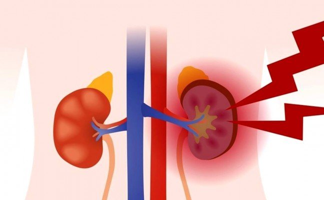 How to Cure Nephritis at Home Naturally?