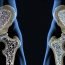 How to Cure Osteoporosis Naturally?