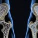 How to Cure Osteoporosis Naturally?