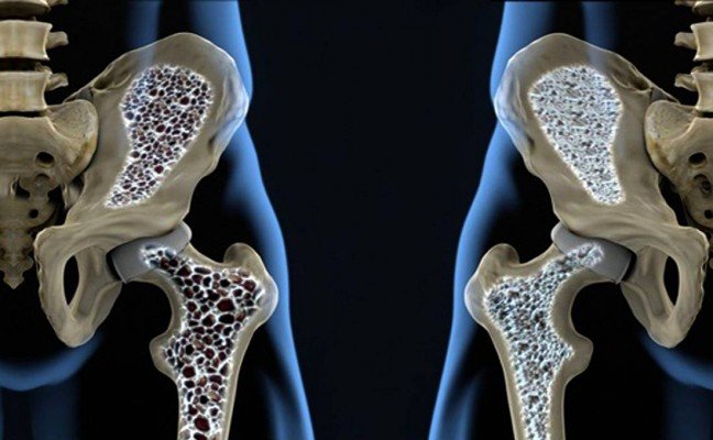 How to Cure Osteoporosis Naturally?