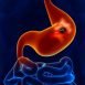 How to Cure Peptic Ulcer at Home Naturally?