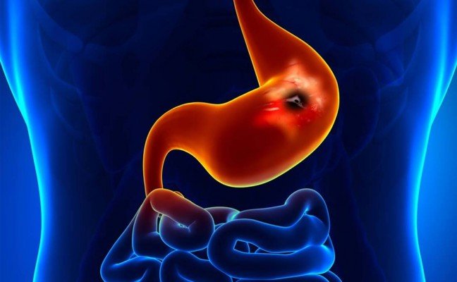 How to Cure Peptic Ulcer at Home Naturally?
