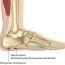 How to Cure Plantar Fascia or Plantar Fasciitis Naturally?