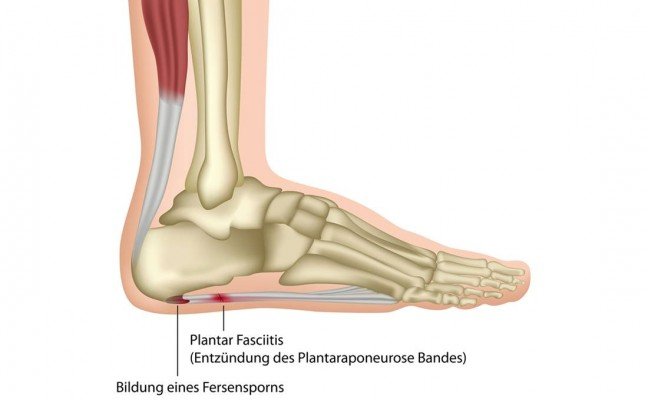 How to Cure Plantar Fascia or Plantar Fasciitis Naturally?