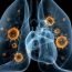How to Cure Pneumonia at Home Naturally?
