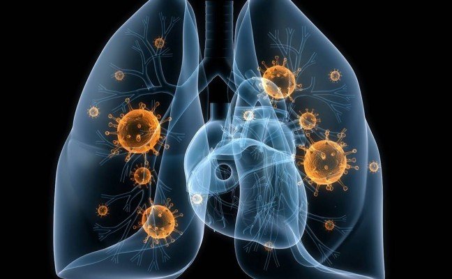 How to Cure Pneumonia at Home Naturally?